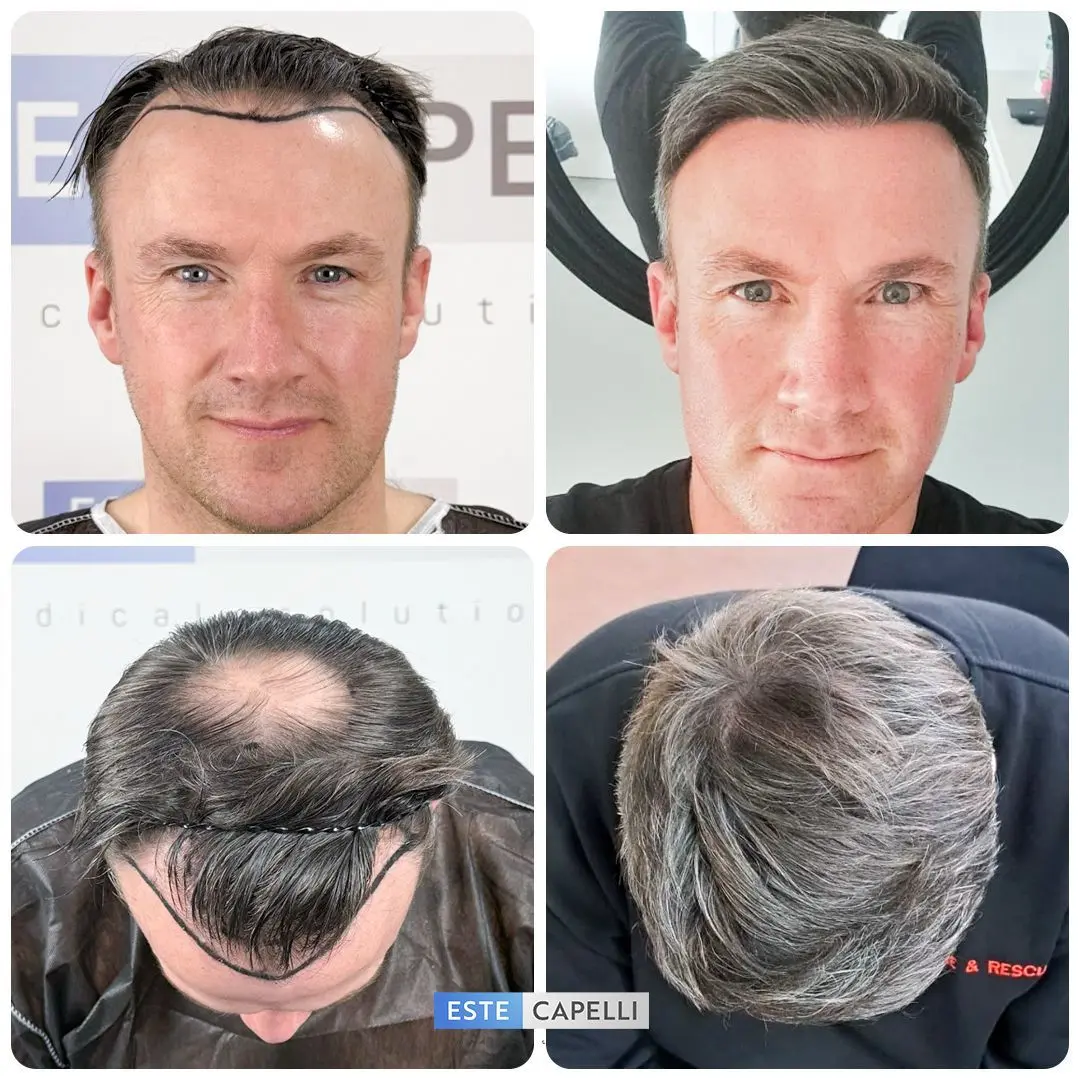 Before and after hair transplant