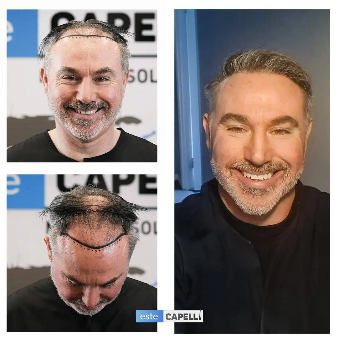 Before and after hair transplant