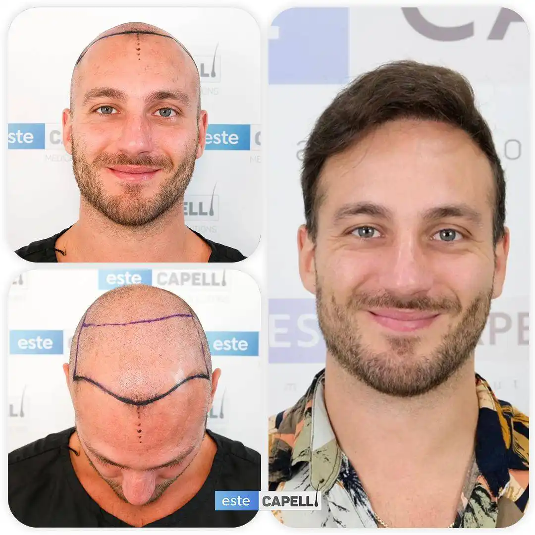 Before and after hair transplant
