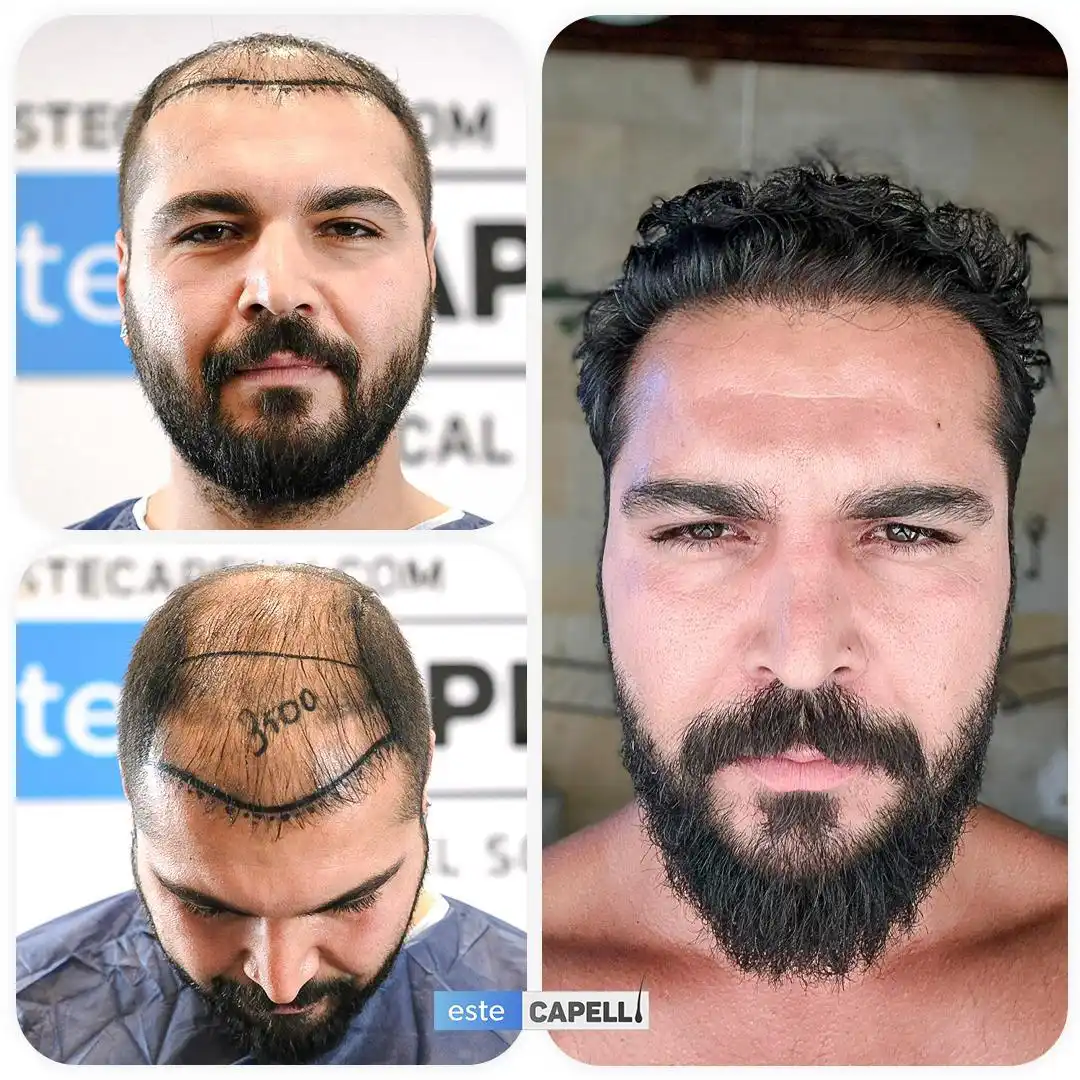 Before and after hair transplant