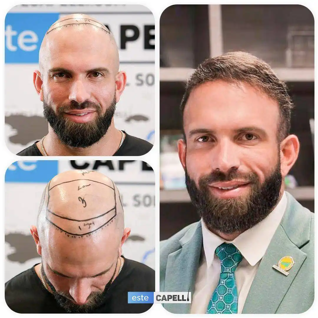 Before and after hair transplant