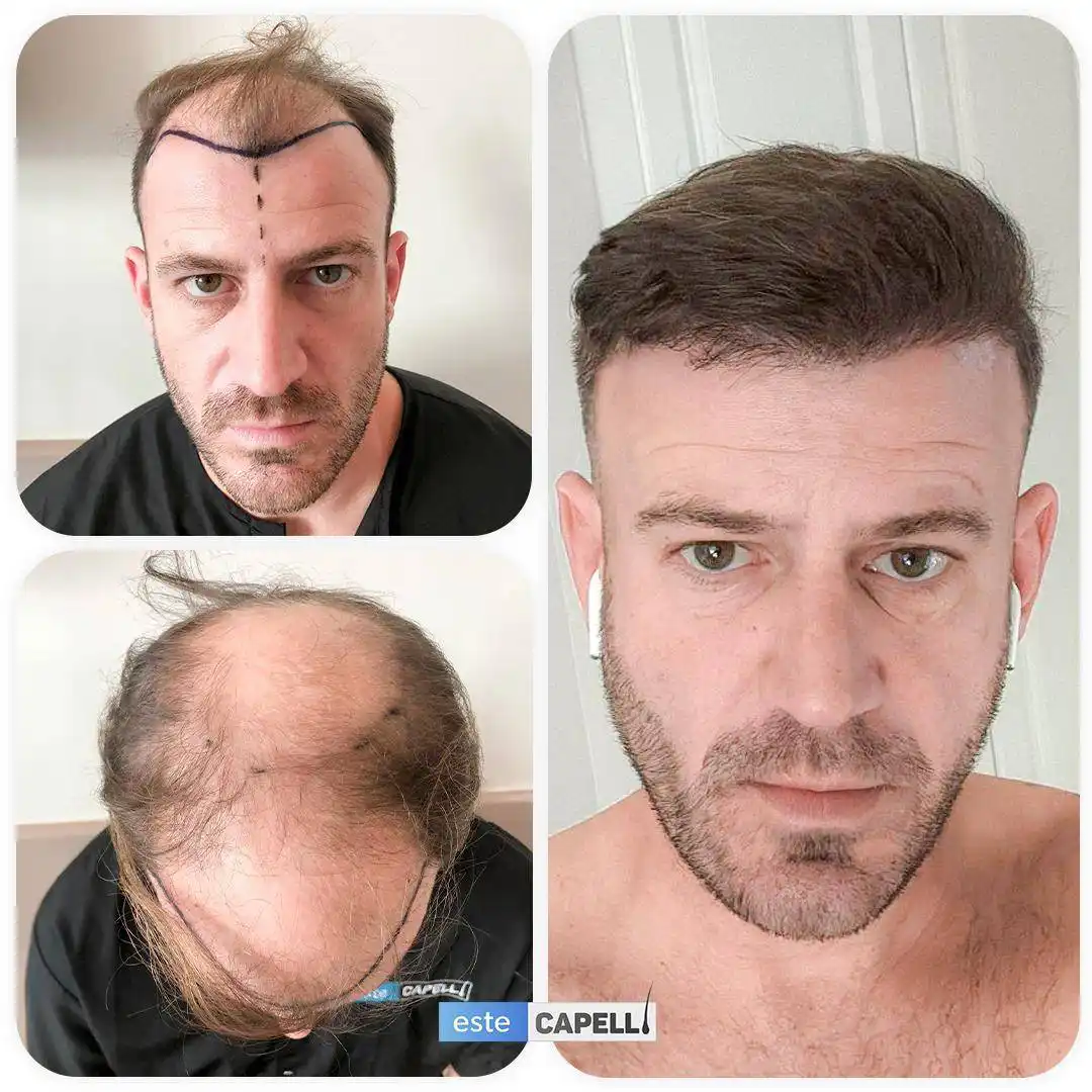 Before and after hair transplant