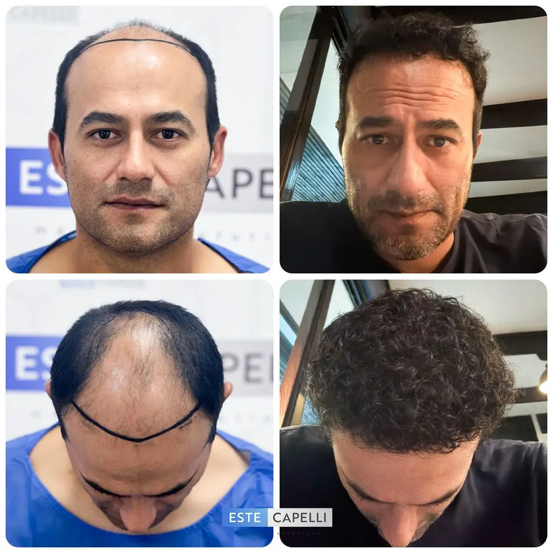Before and after hair transplant
