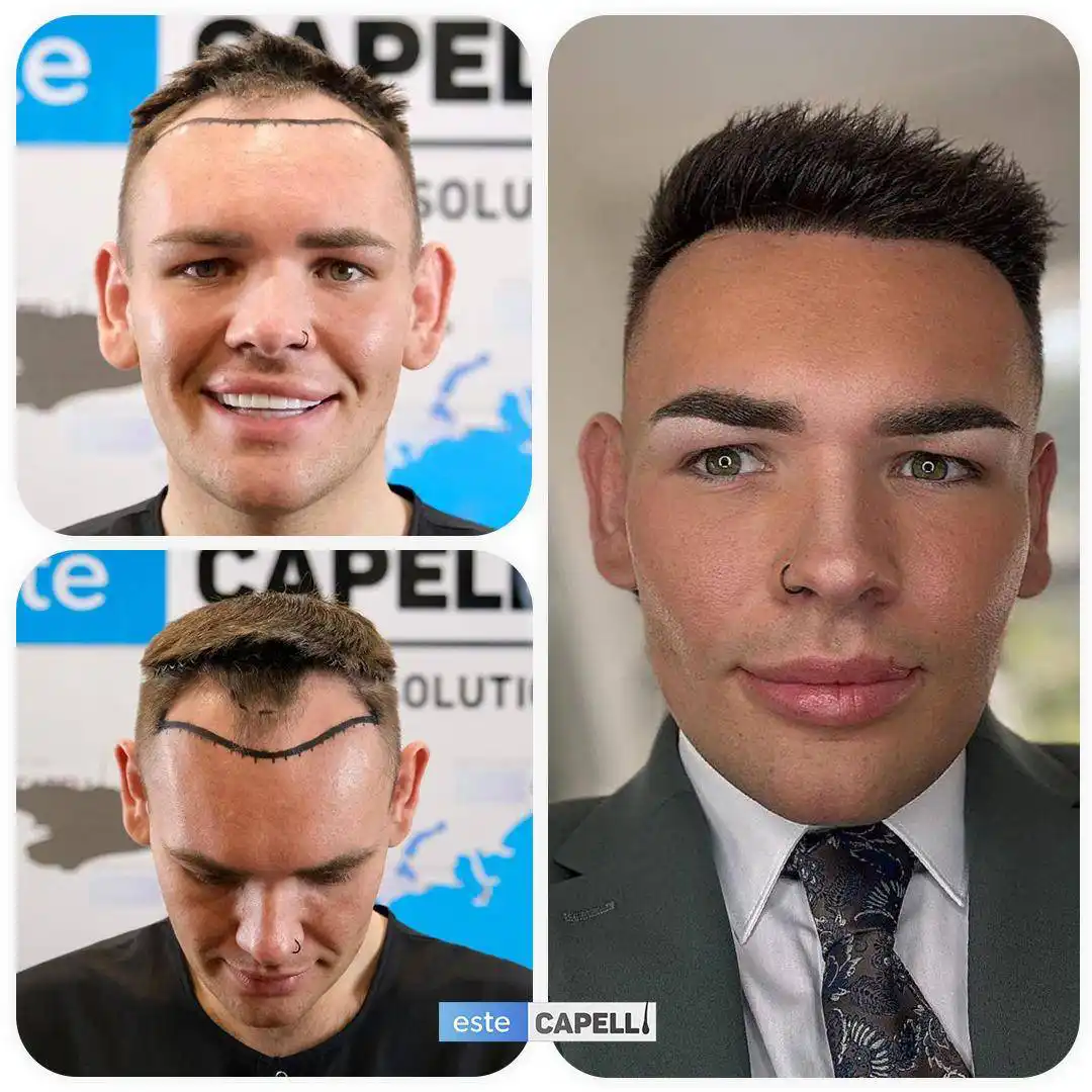 Before and after hair transplant