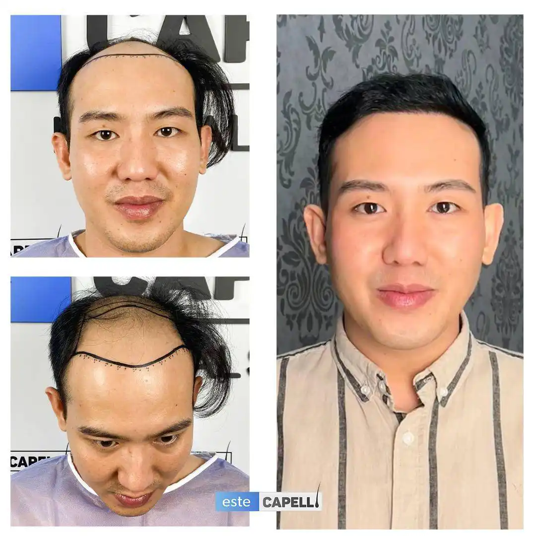Before and after hair transplant