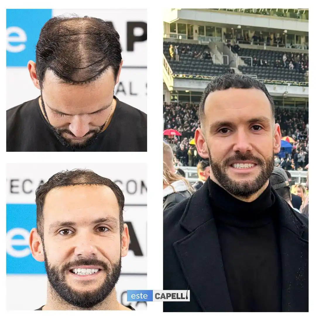 Before and after hair transplant