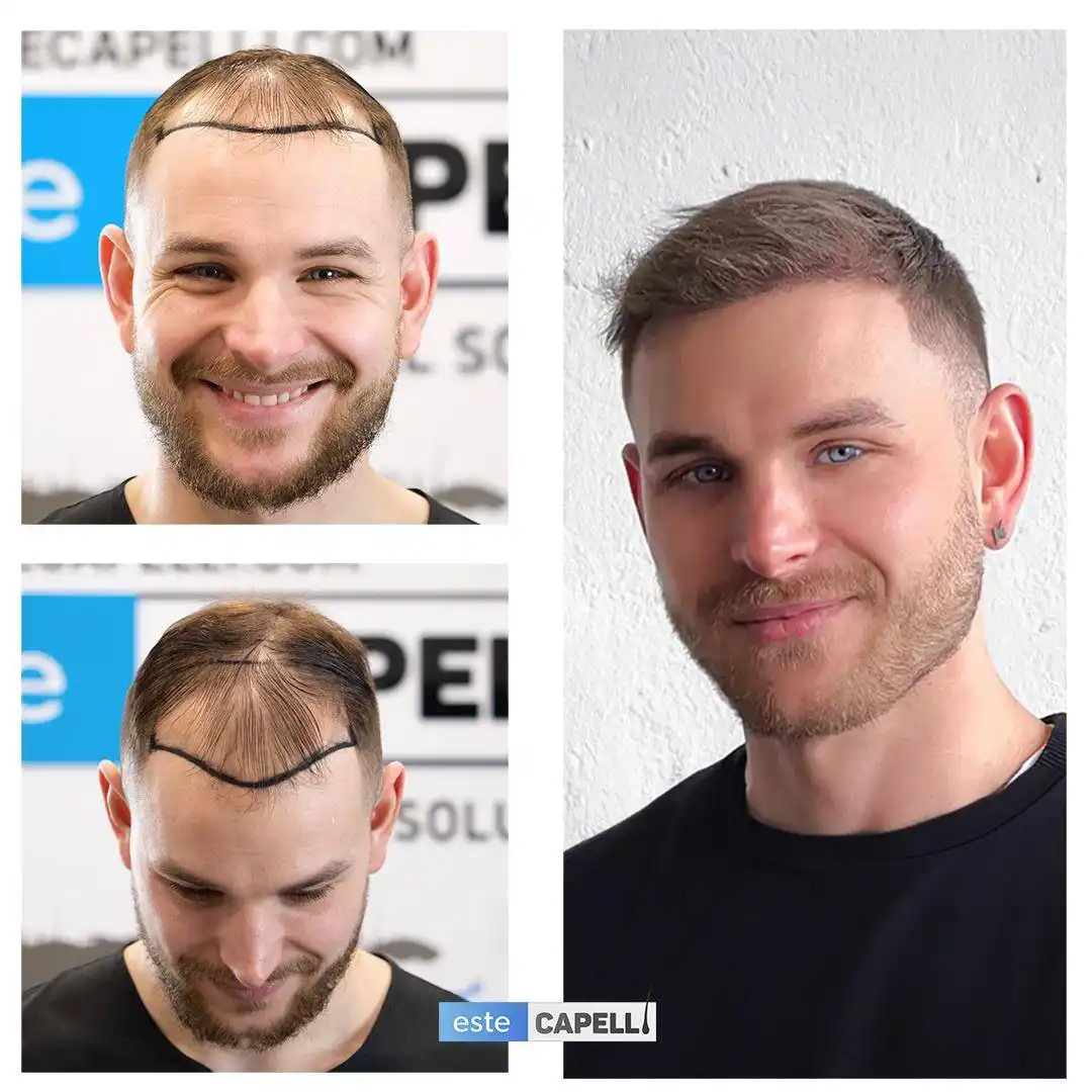 Before and after hair transplant