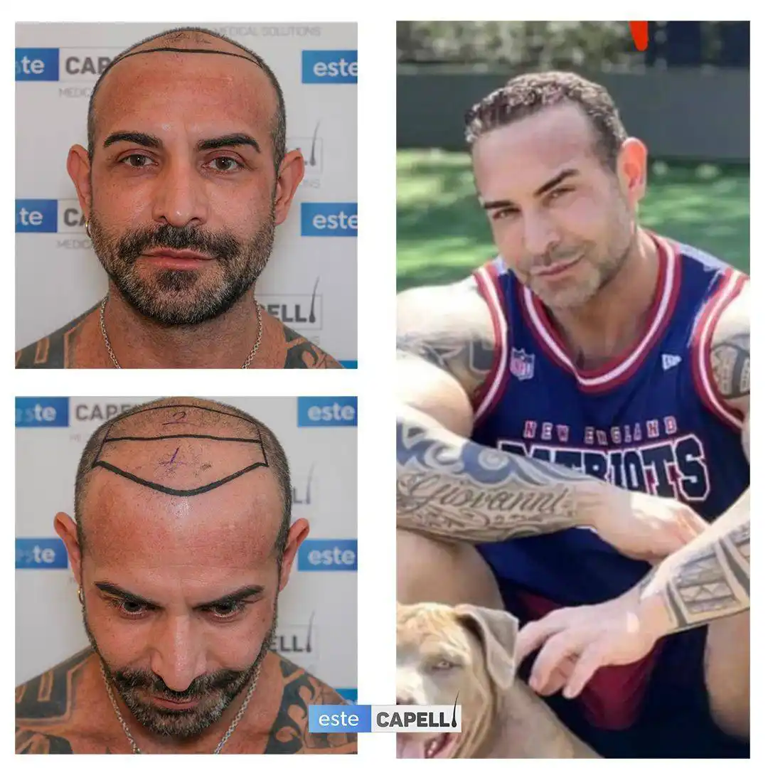 Before and after hair transplant
