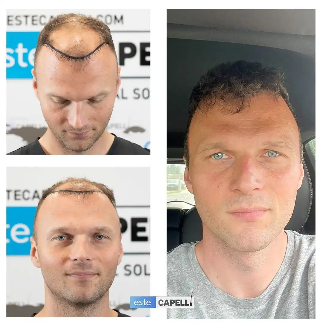 Before and after hair transplant