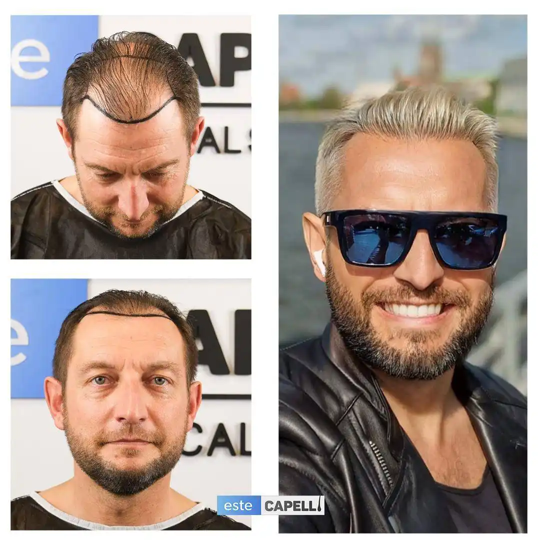 Before and after hair transplant