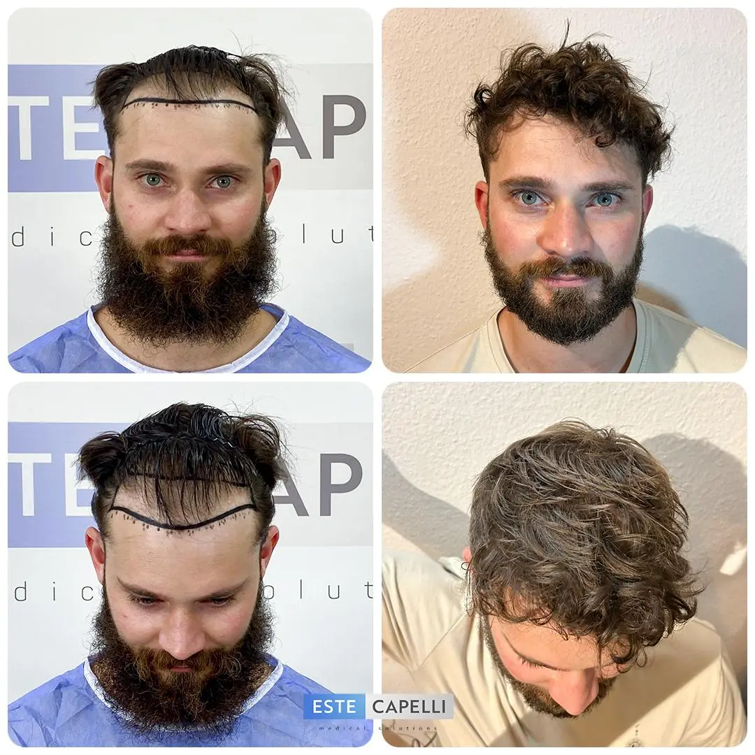 Before and after hair transplant
