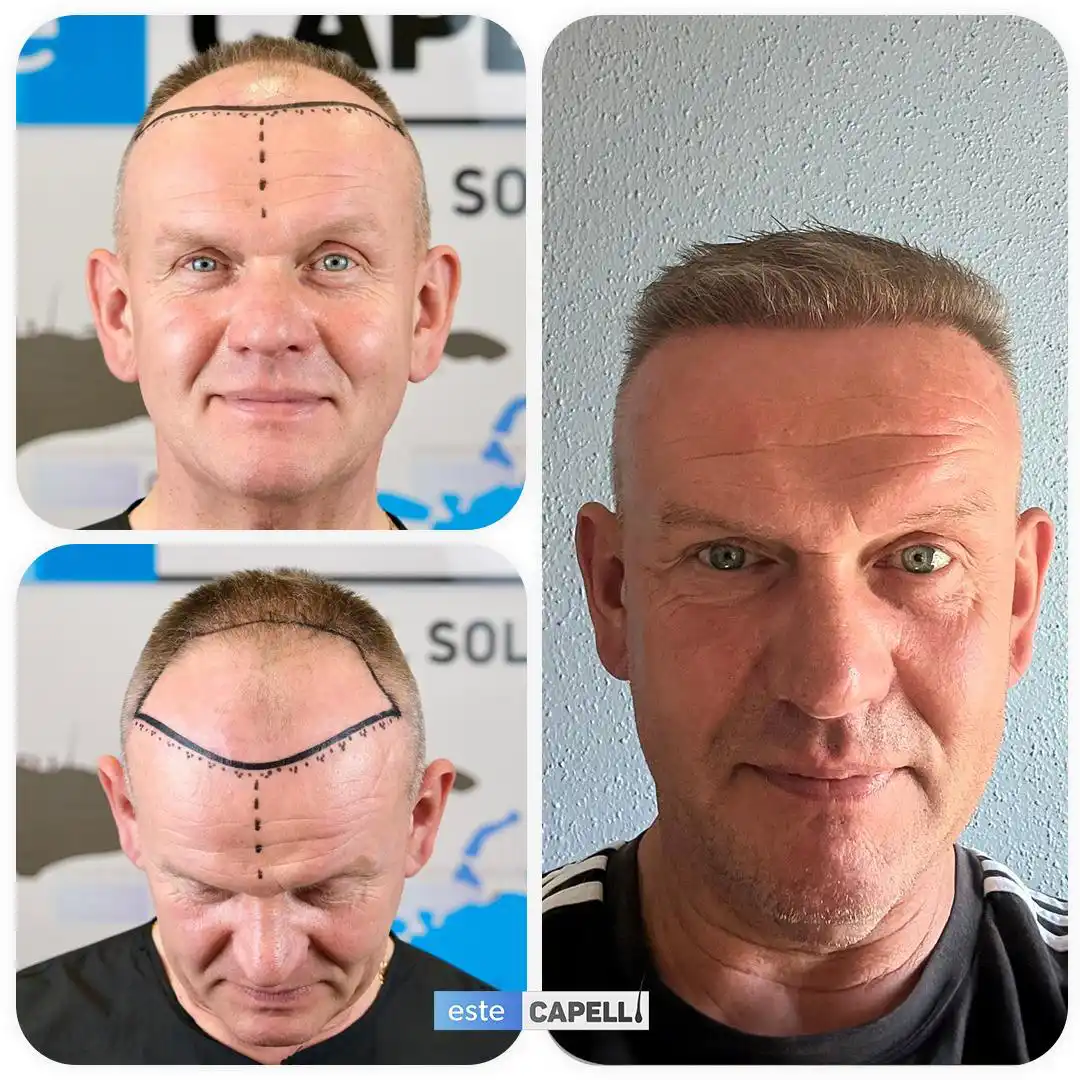 Before and after hair transplant
