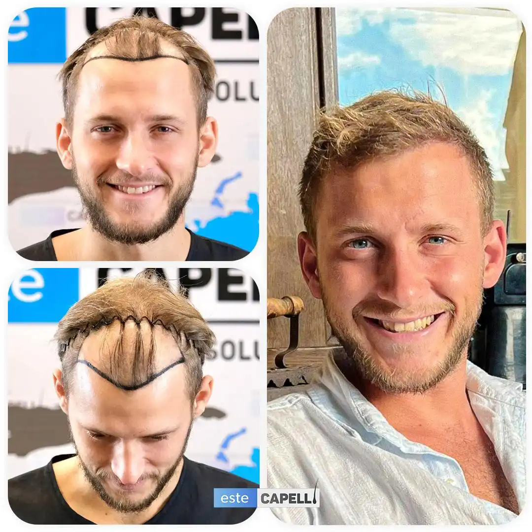 Before and after hair transplant