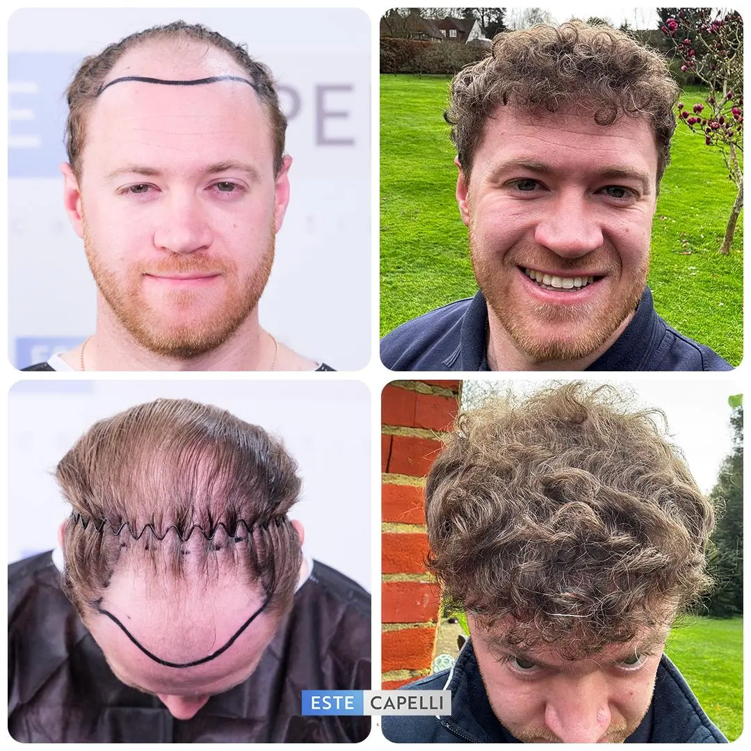 Before and after hair transplant