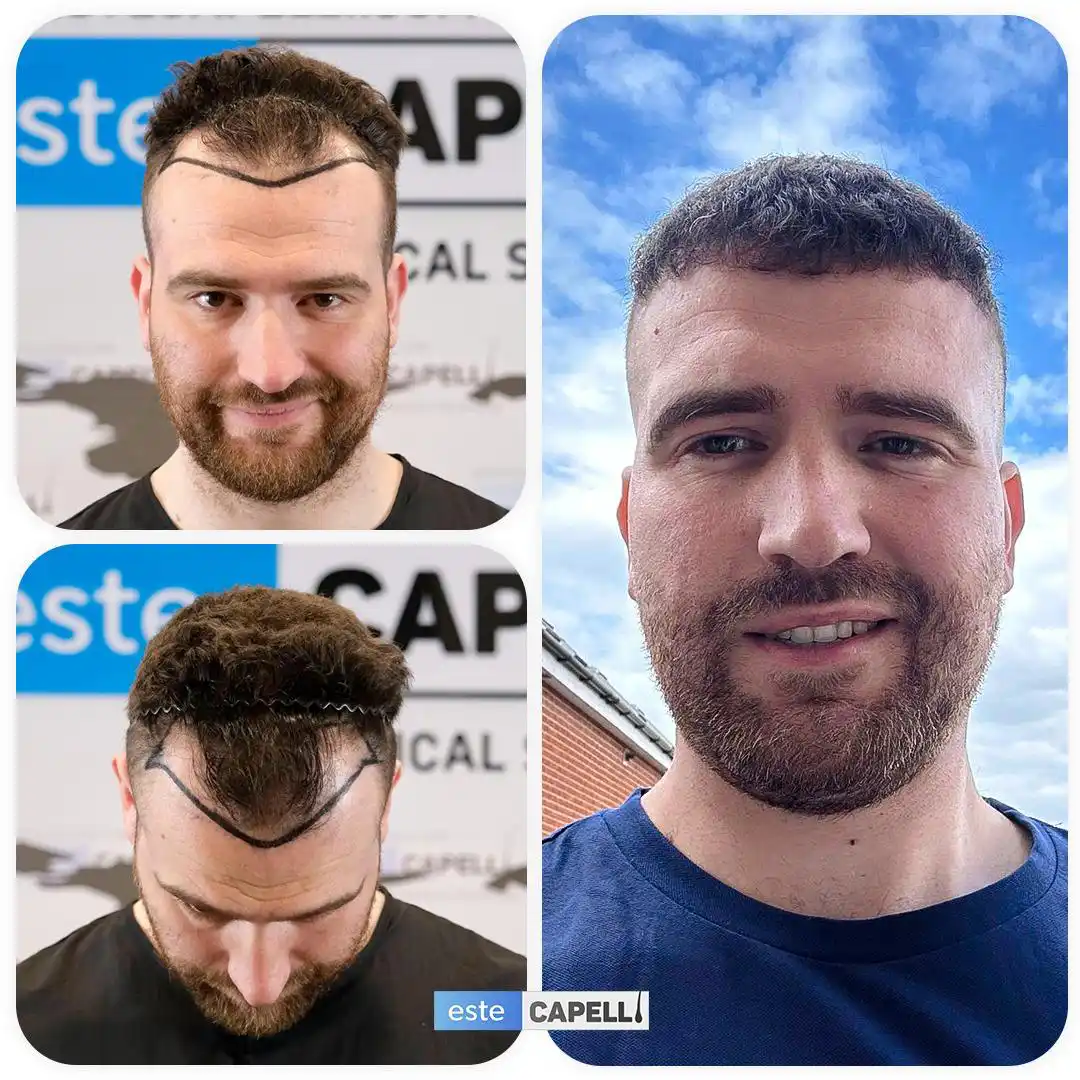 Before and after hair transplant
