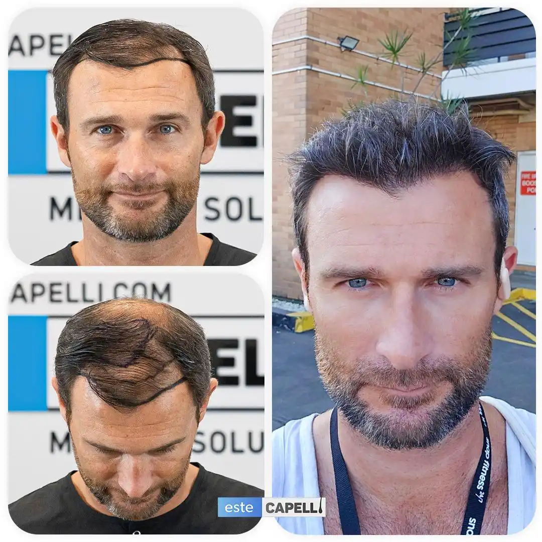 Before and after hair transplant